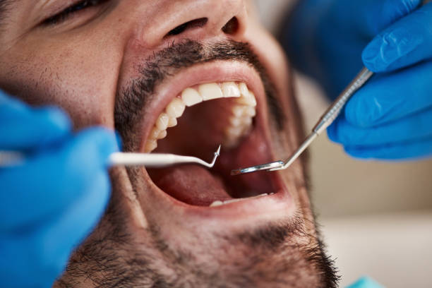Best Emergency Dental Care for Broken or Chipped Teeth in Southgate, MI